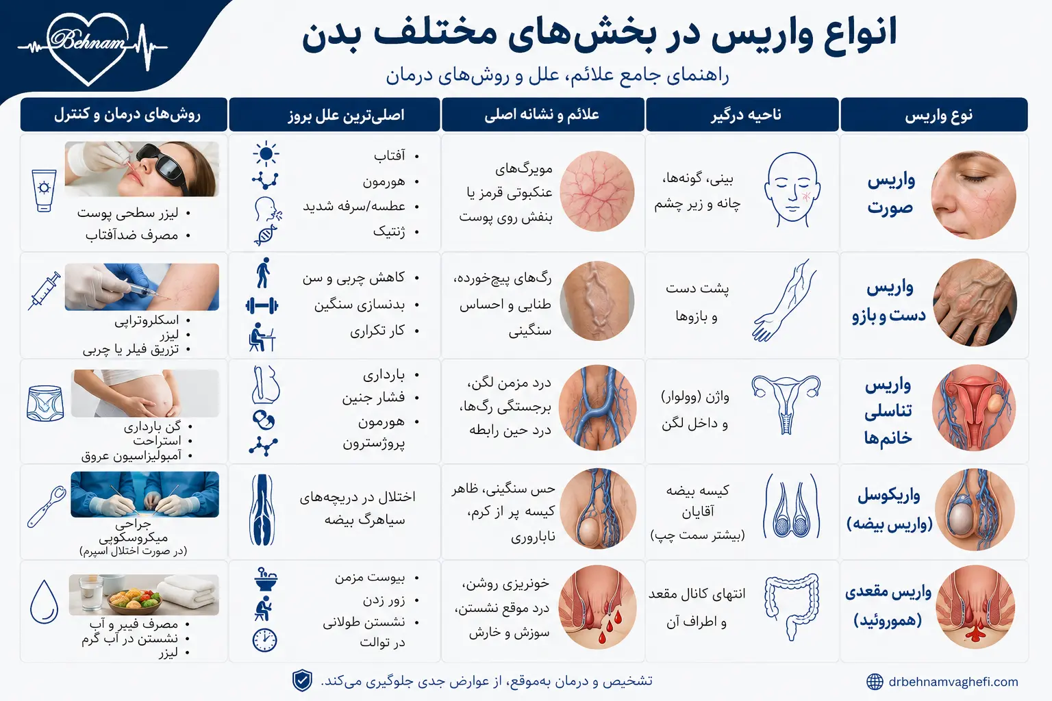 انواع واریس بدن