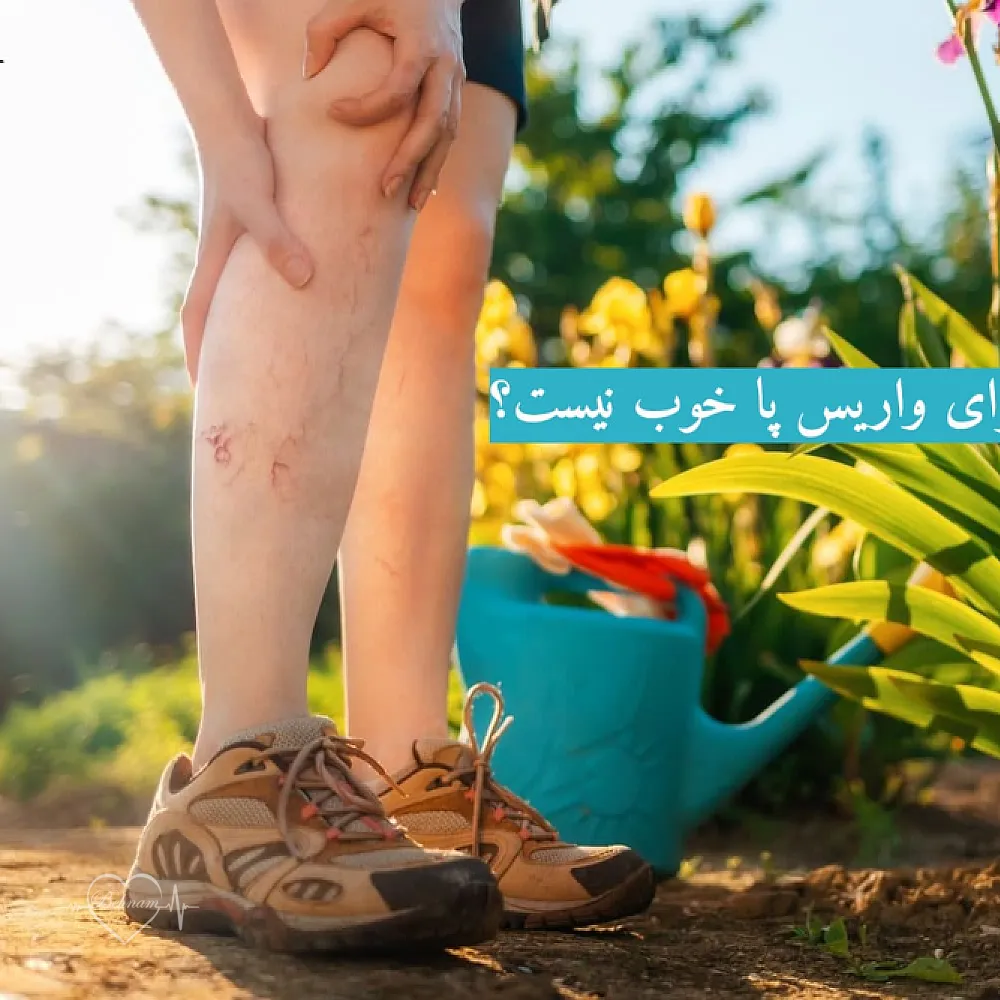 چرا گرما برای واریس پا خوب نیست و چه باید کرد؟