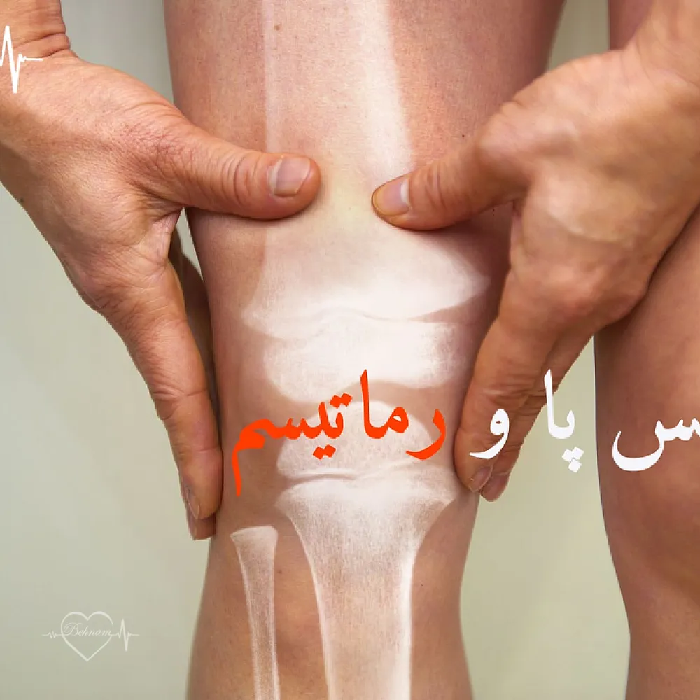 تفاوت و فرق واریس پا و رماتیسم: مقایسه و ارتباط