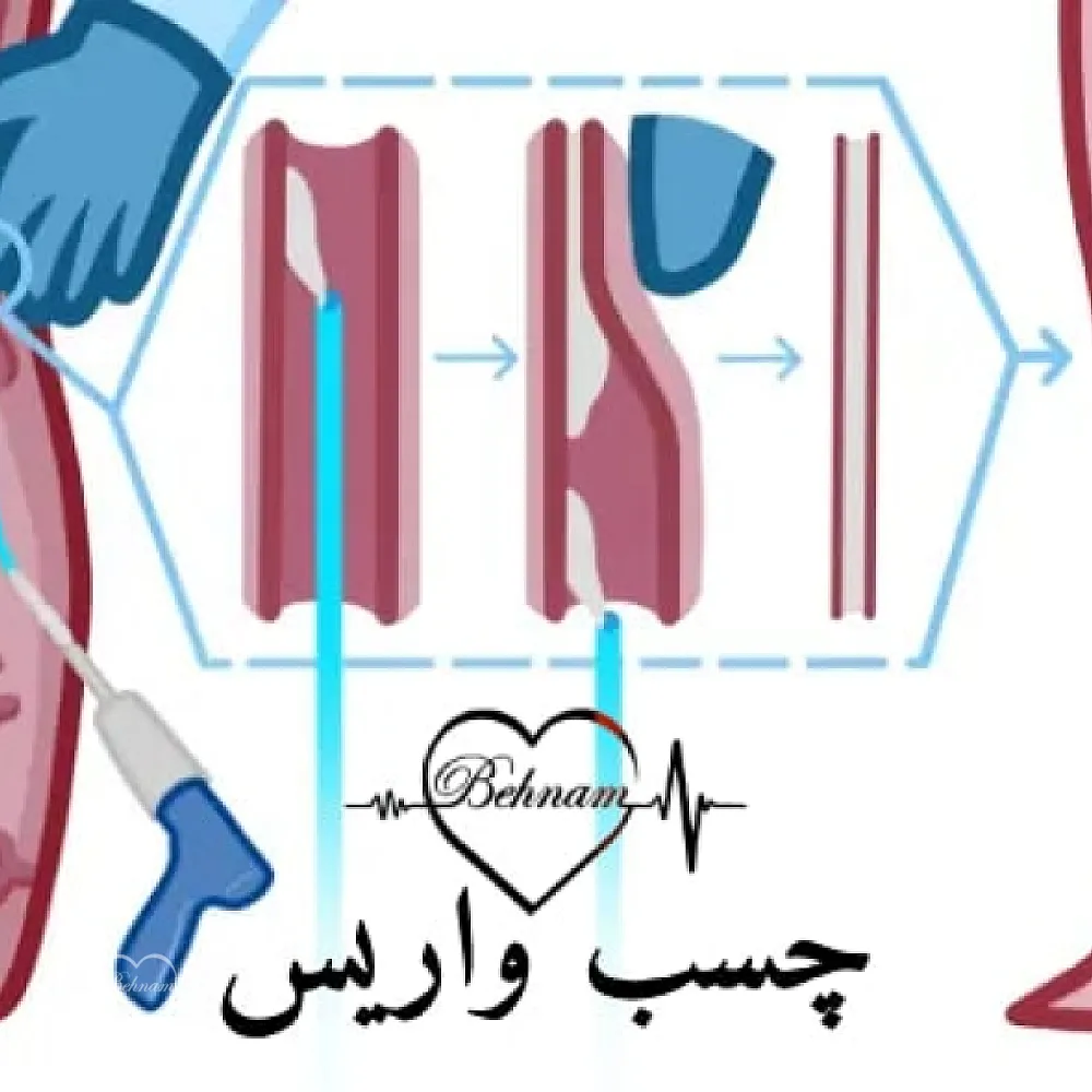 چسب واریس (وناسیل): بررسی شیوه انجام، تاثیر و مزایا، عوارض و مراقبت ها