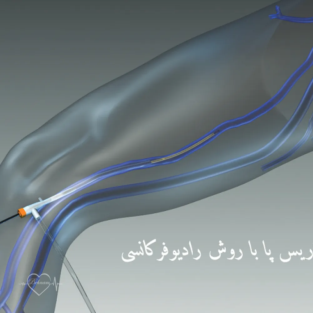 درمان واریس پا با روش نوین رادیوفرکانسی (RF)