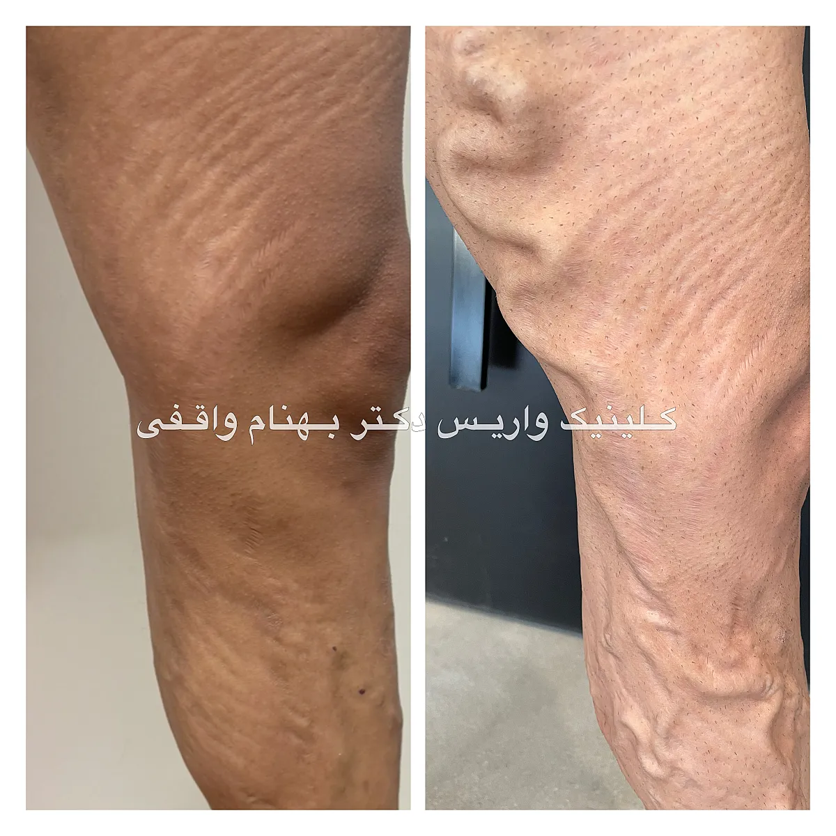 نمونه درمان موفق واریس طنابی گسترده