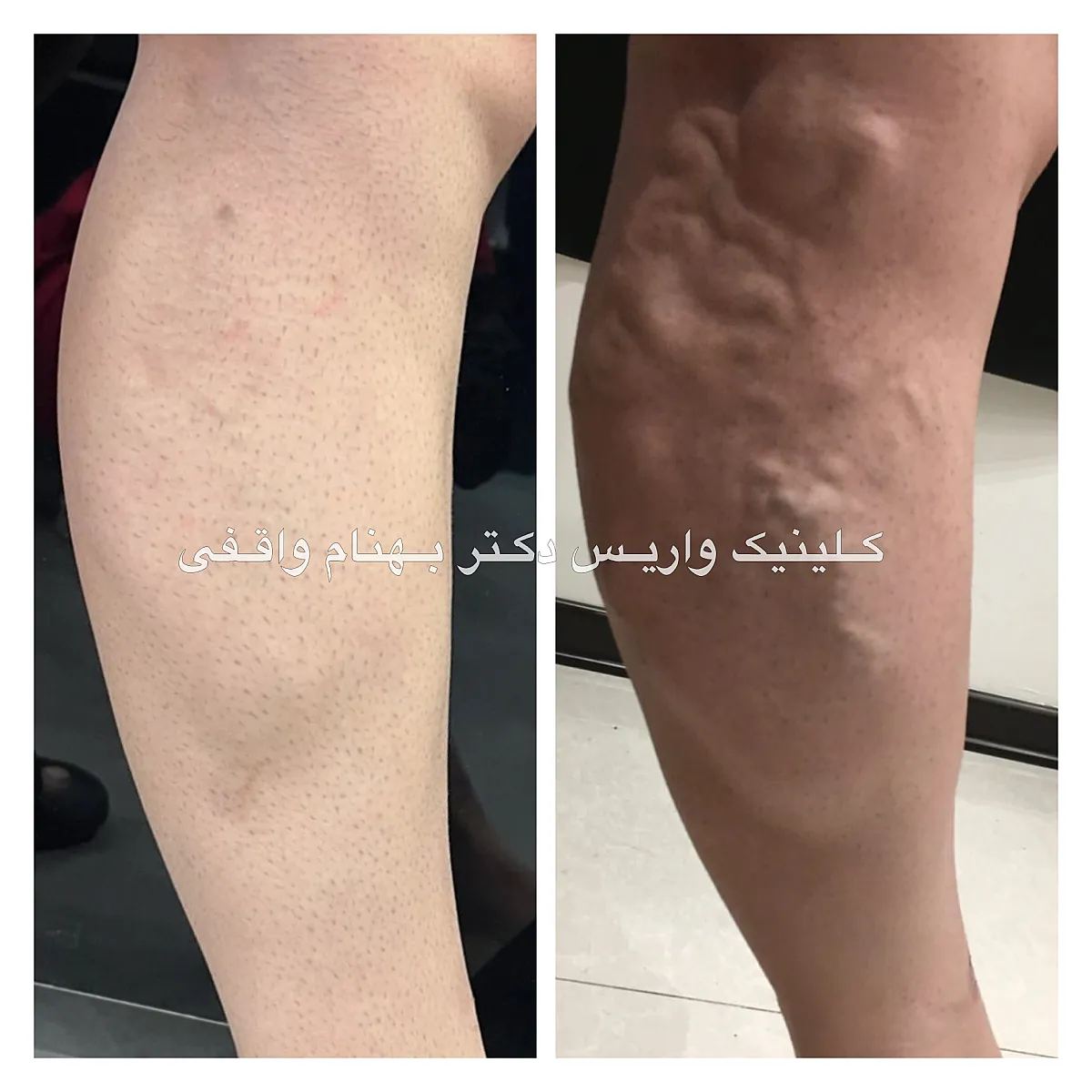 نمونه درمان موفق واریس طنابی پشت ساق پا