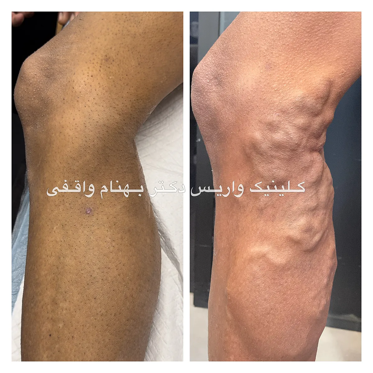 نمونه درمان موفق بیماران واریس پا