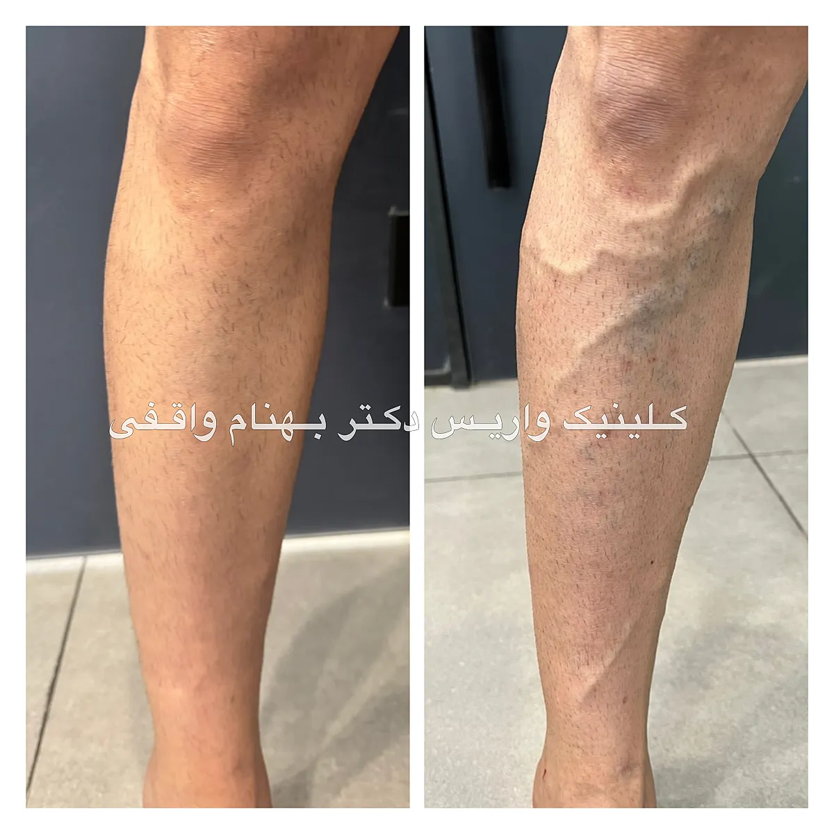 نمونه درمان موفق واریس زانو