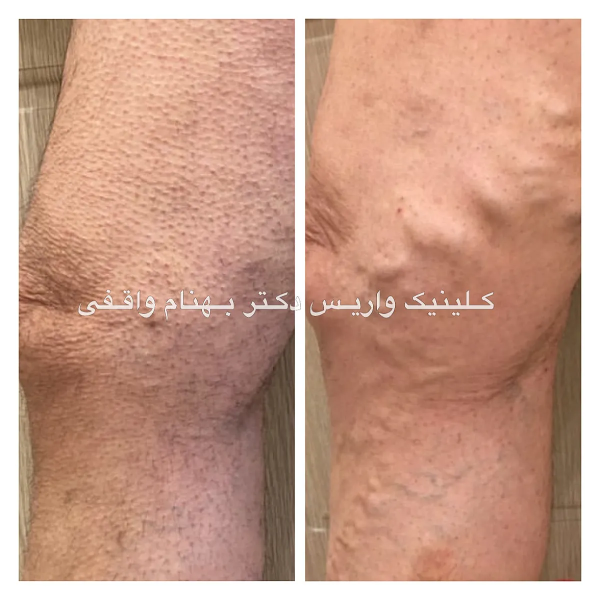 نمونه درمان موفق واریس طنابی ران