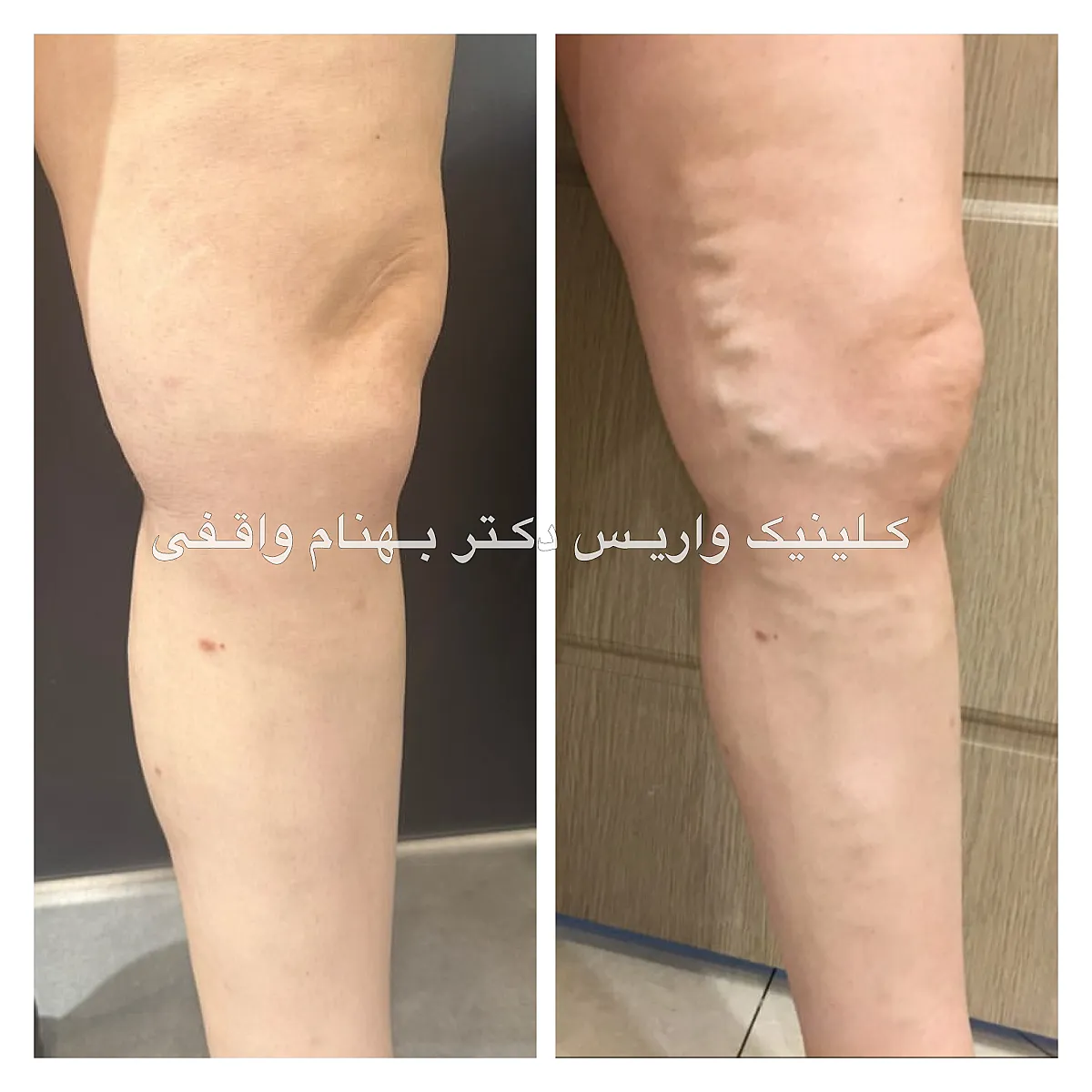 درمان موفق واریس 