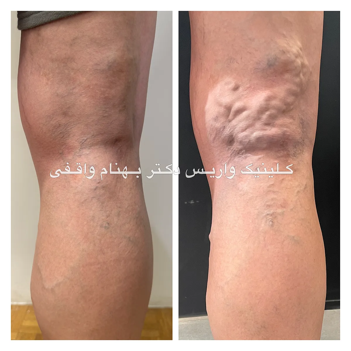 نمونه های درمان واریس