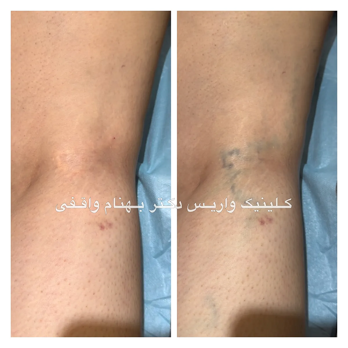 نمونه درمان موفق واریس مشبک