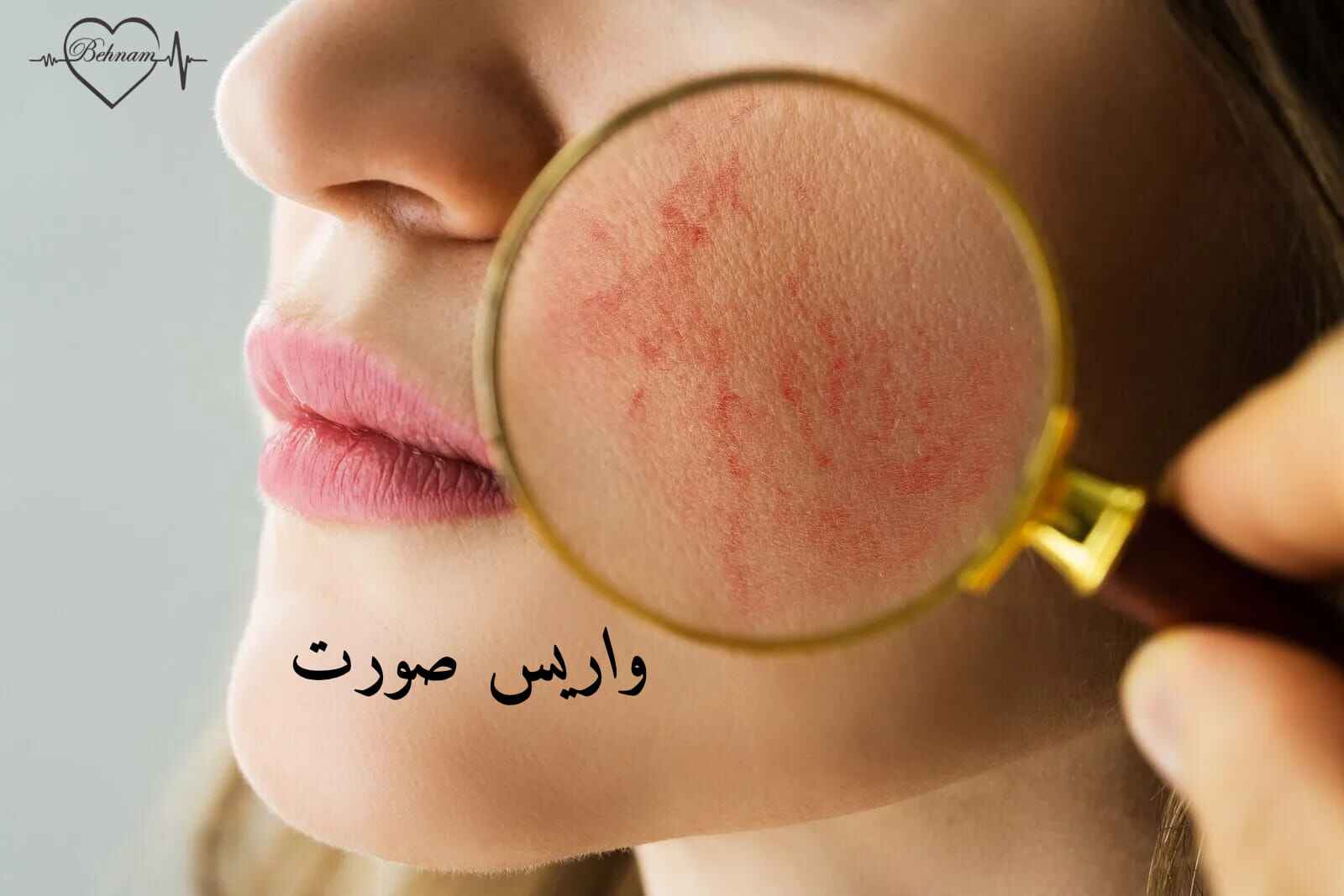واریس صورت: گفته ها و نگفته ها از تشخیص تا درمان
