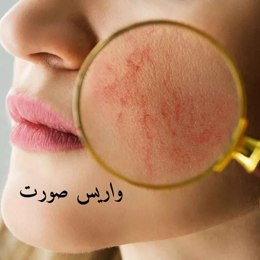 Facial Varicose Veins: The Said and the Unsaid, from Diagnosis to Treatment