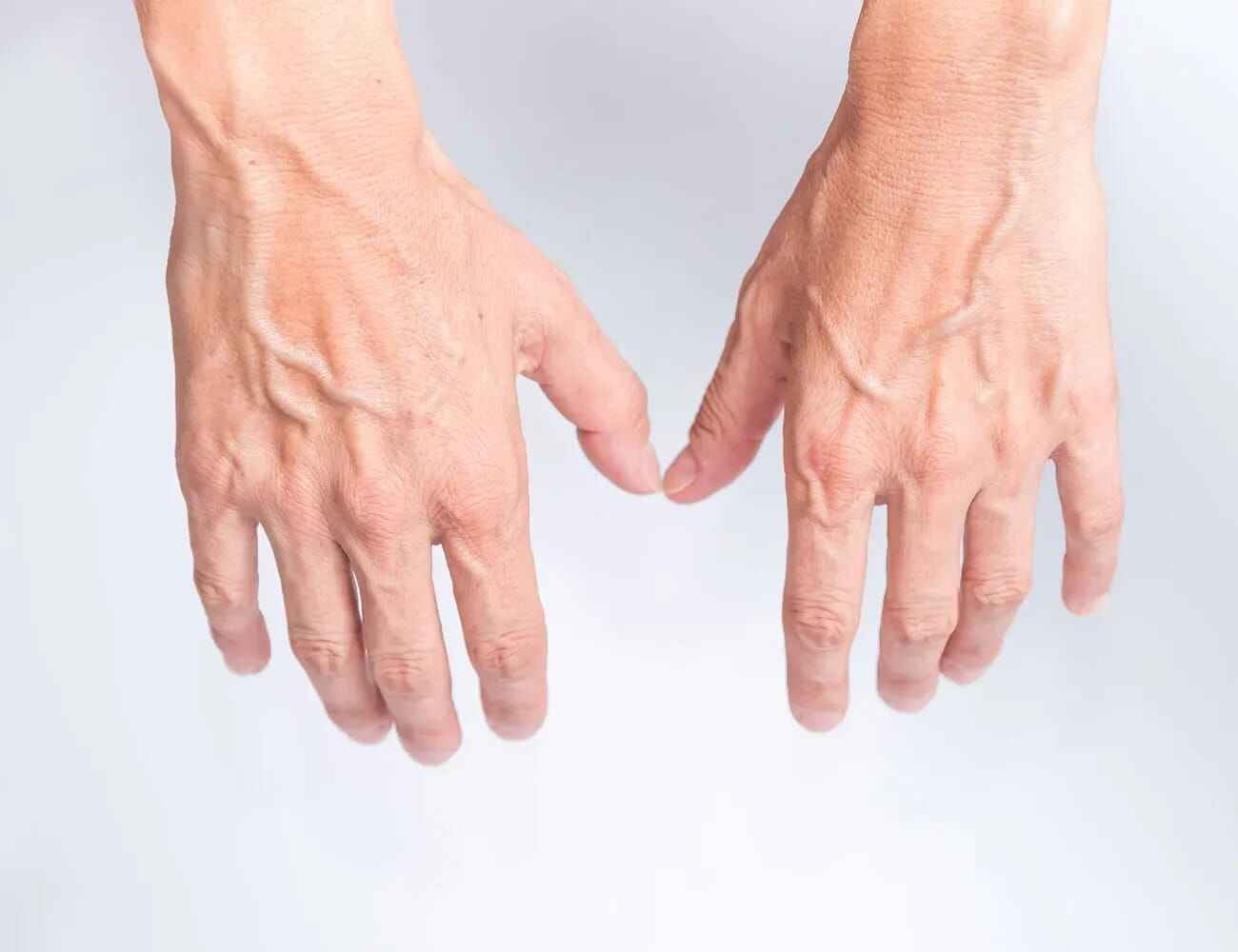 علت واریس دست: علائم + انواع + پیشگیری و درمان