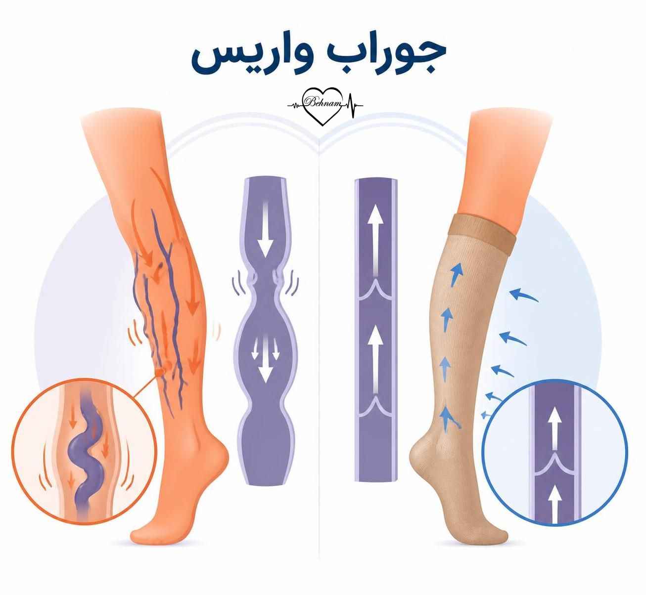 جوراب واریس:انواع، نحوه استفاده و شستن + مزایا و عوارض