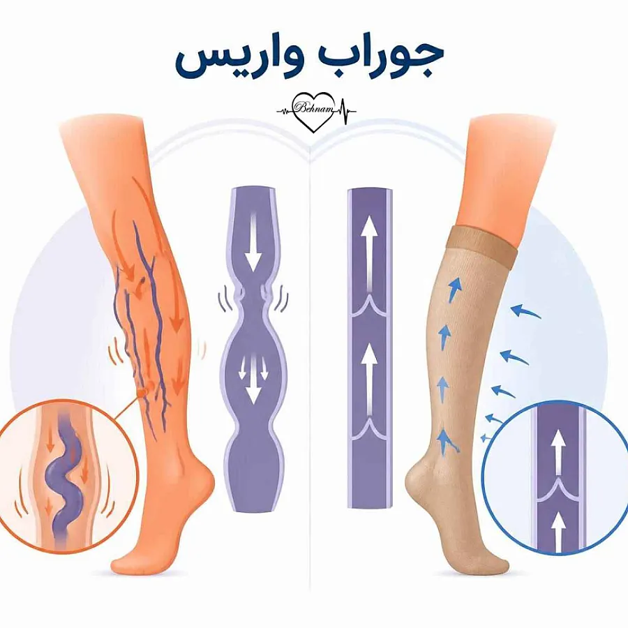 جوراب واریس:انواع، نحوه استفاده و شستن + مزایا و عوارض