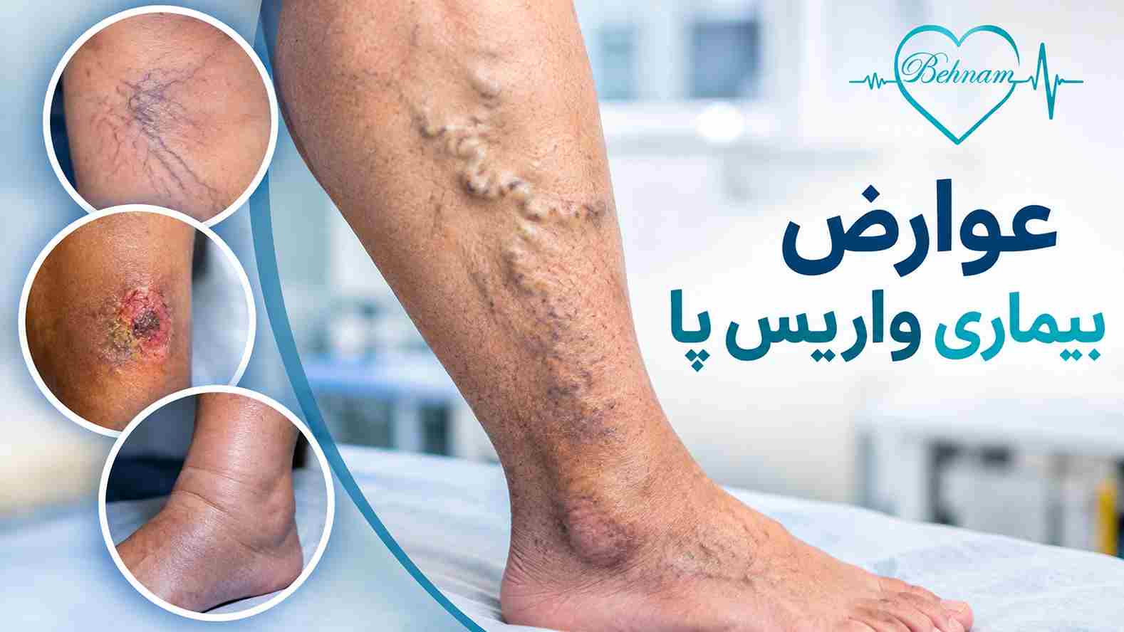  عوارض بیماری واریس پا | بررسی کامل