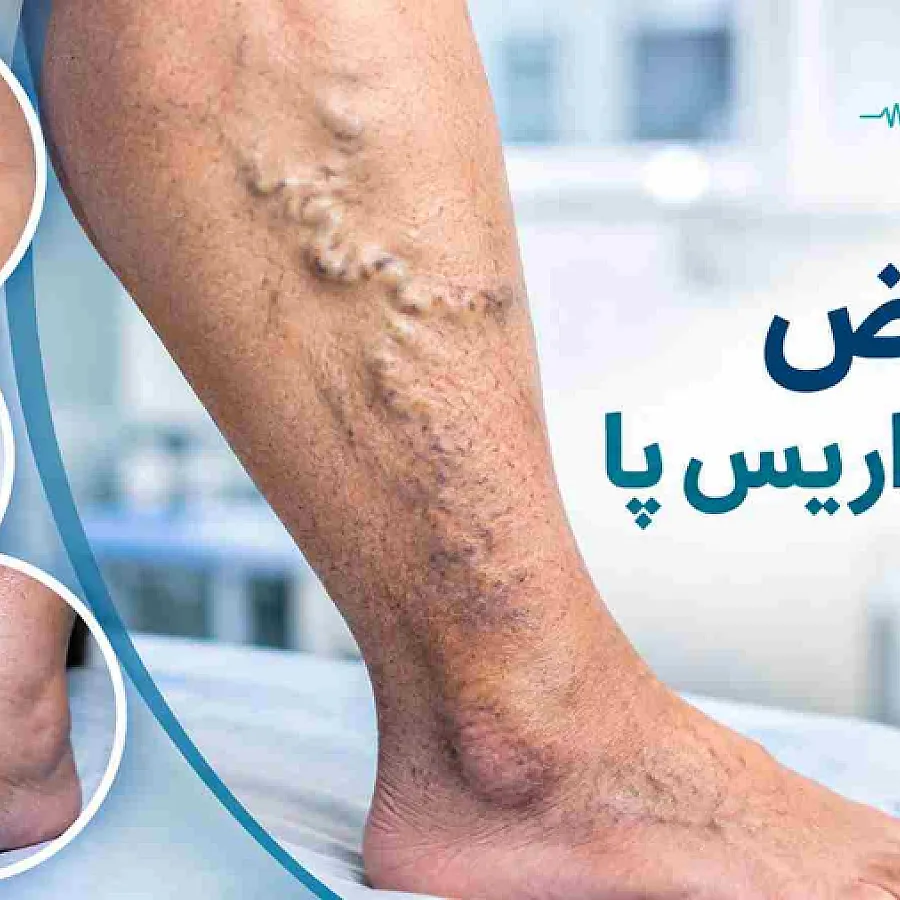 Complications of Varicose Veins: A Complete Guide