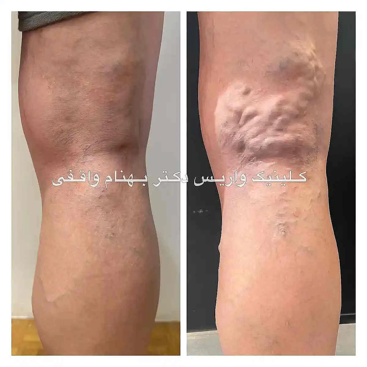 نمونه های درمان واریس