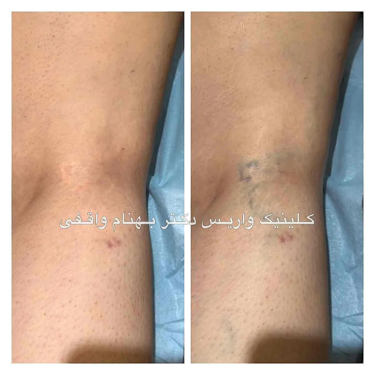 نمونه درمان موفق واریس مشبک