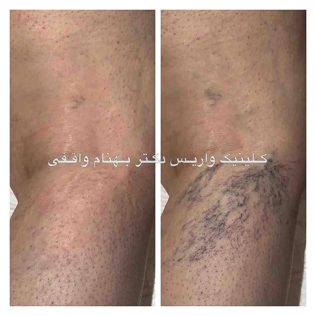 نمونه درمان واریس عنکبوتی