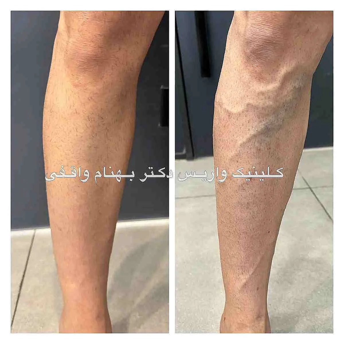 نمونه درمان موفق واریس زانو