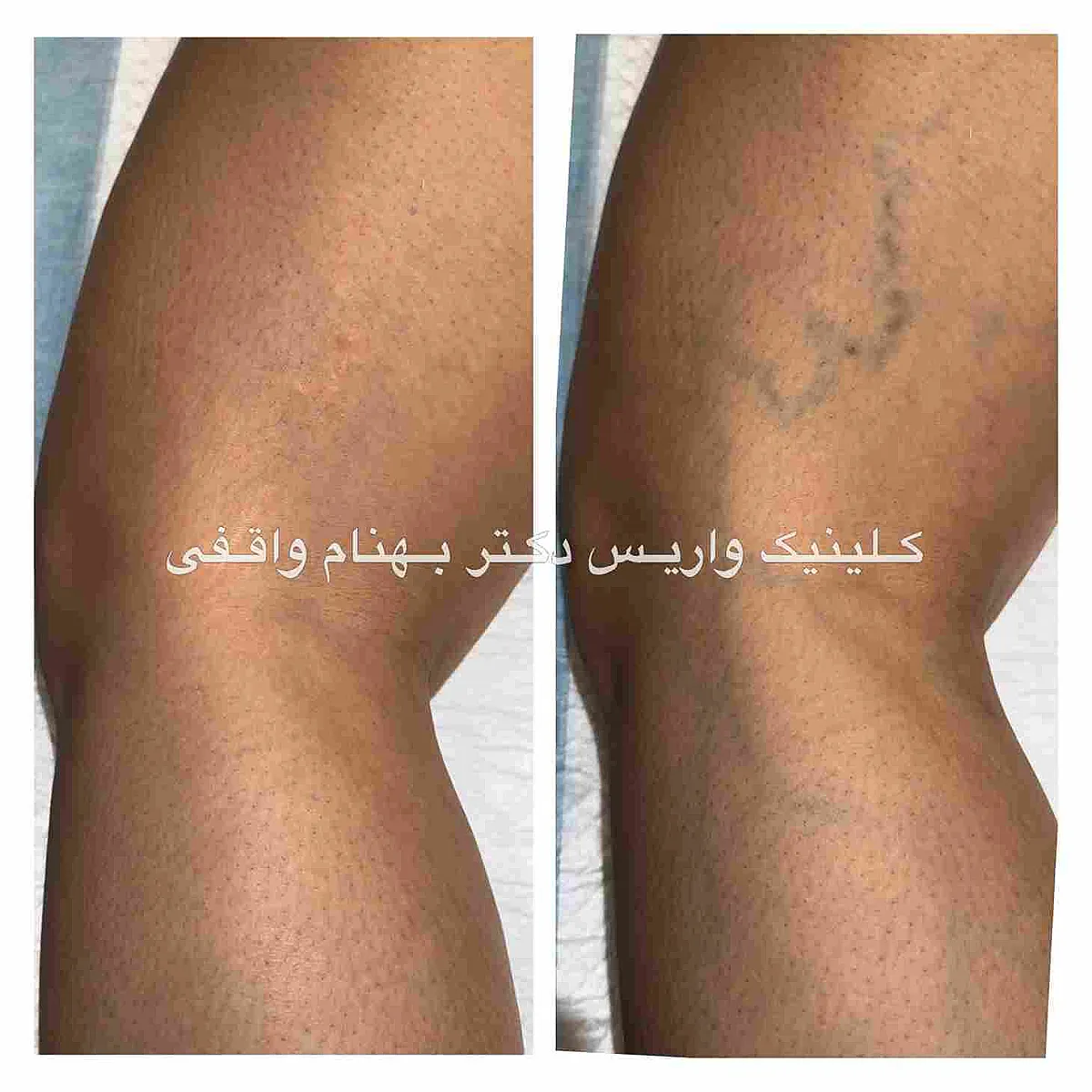 نمونه درمان موفق واریس رتیکولار