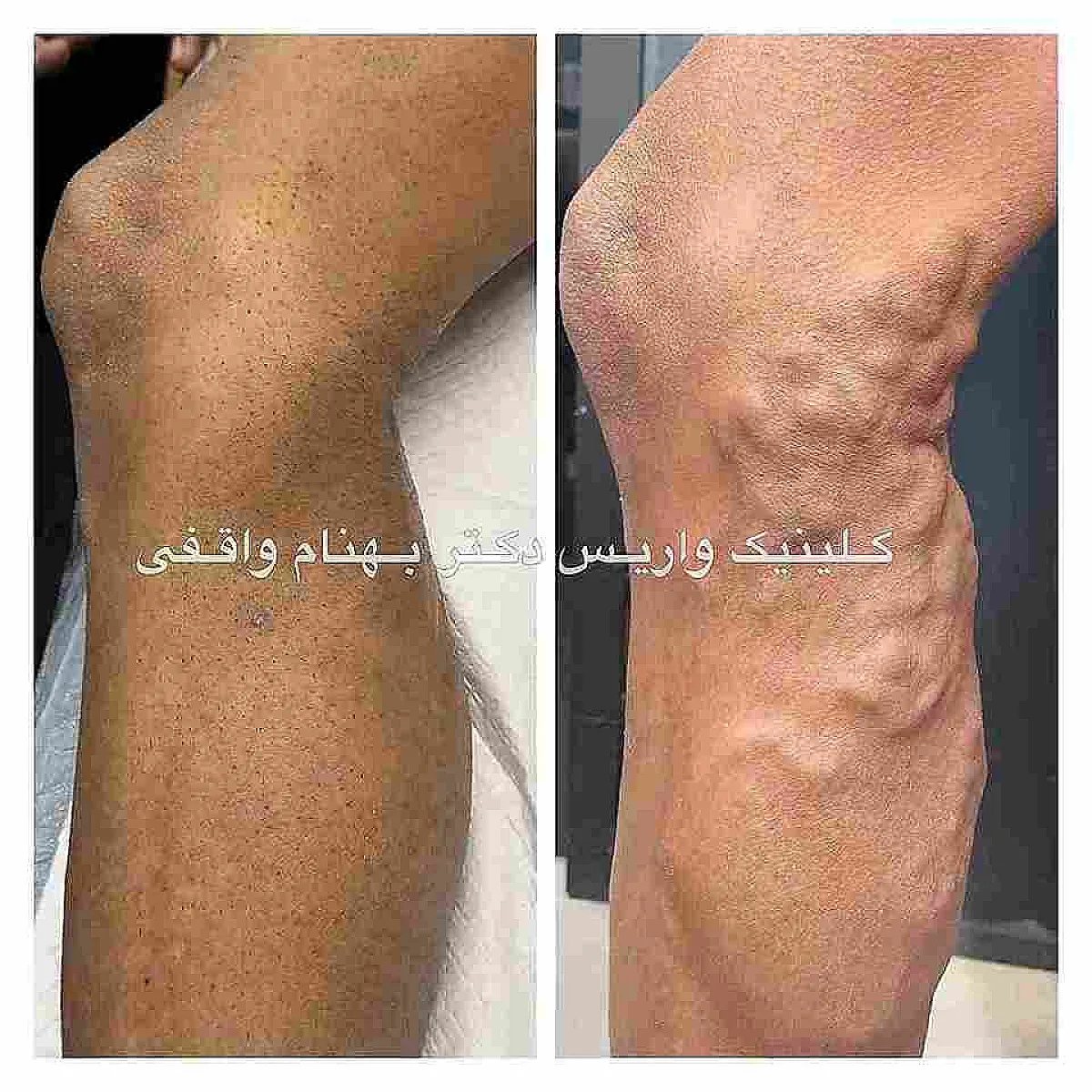 نمونه درمان موفق بیماران واریس پا