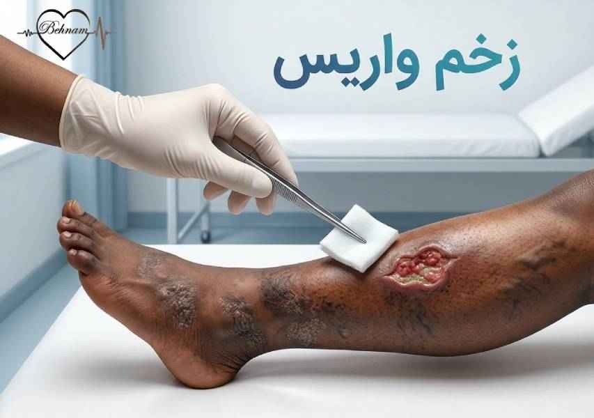  زخم واریس | چگونگی ایجاد و درمان