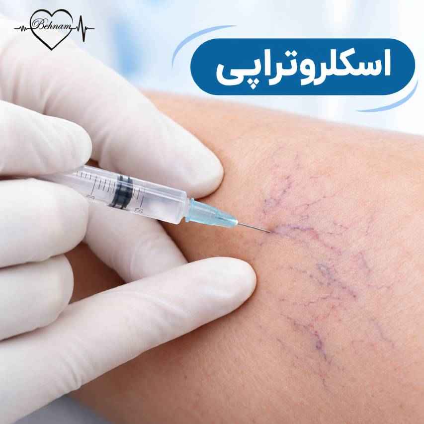 اسکلروتراپی واریس پا: مزایا و عوارض + فیلم تزریق