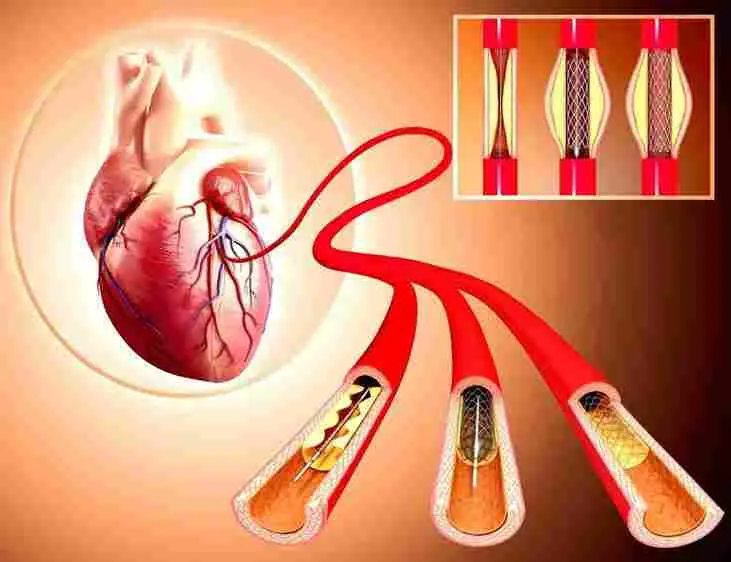 آنژیوگرافی و آنژیوپلاستی