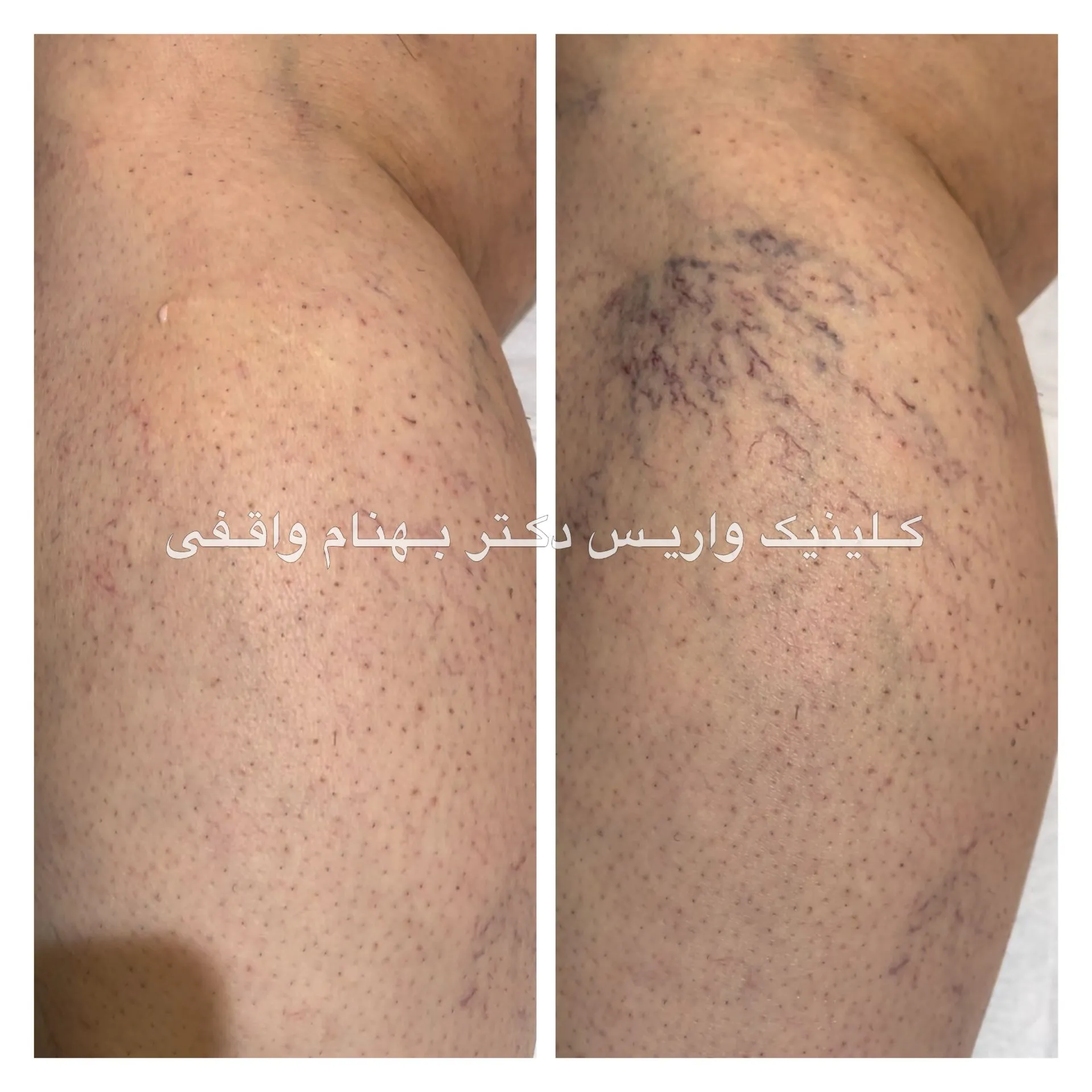 قبل و بعد اسکلروتراپی واریس عنکبوتی پا