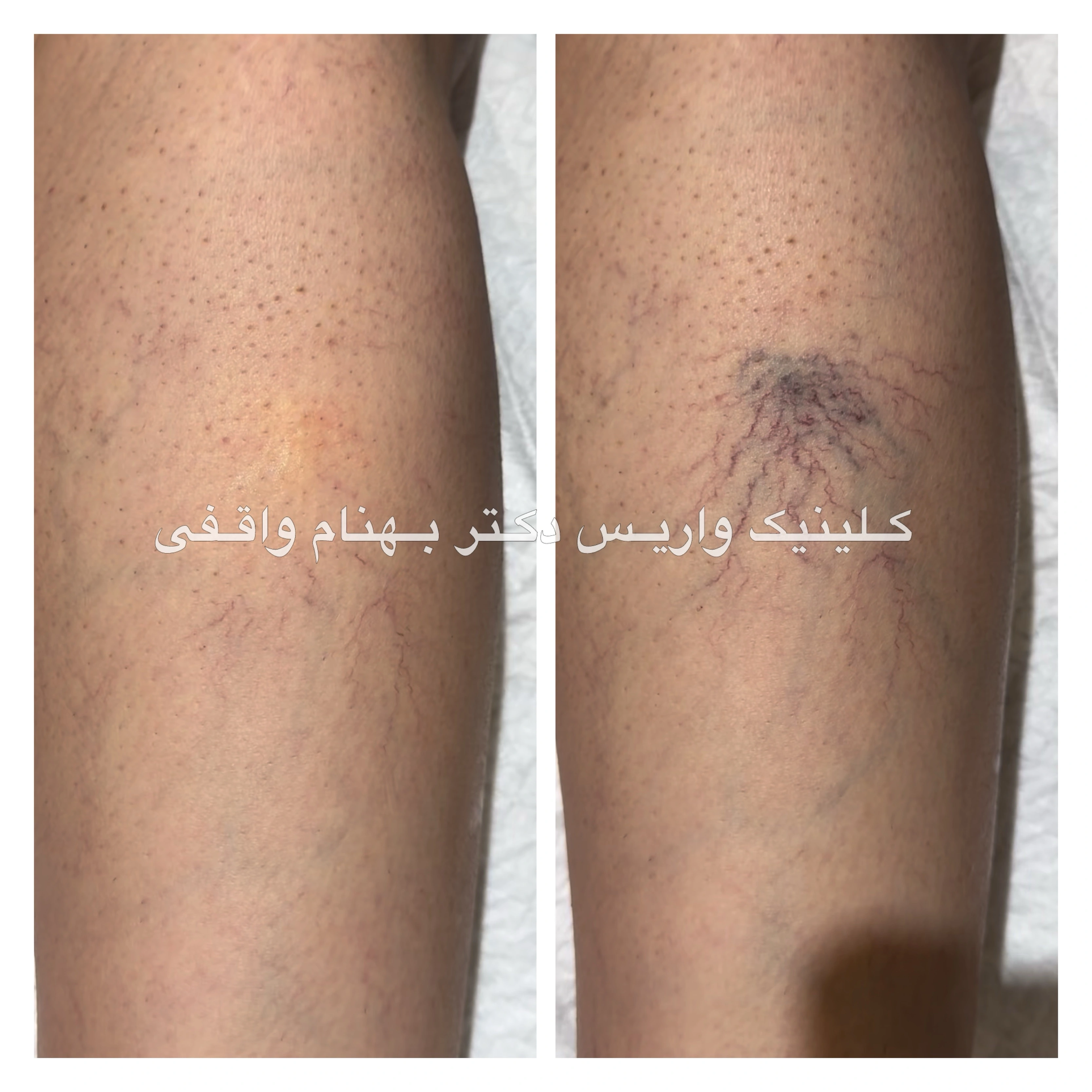 درمان اسکلروتراپی واریس عنکبوتی