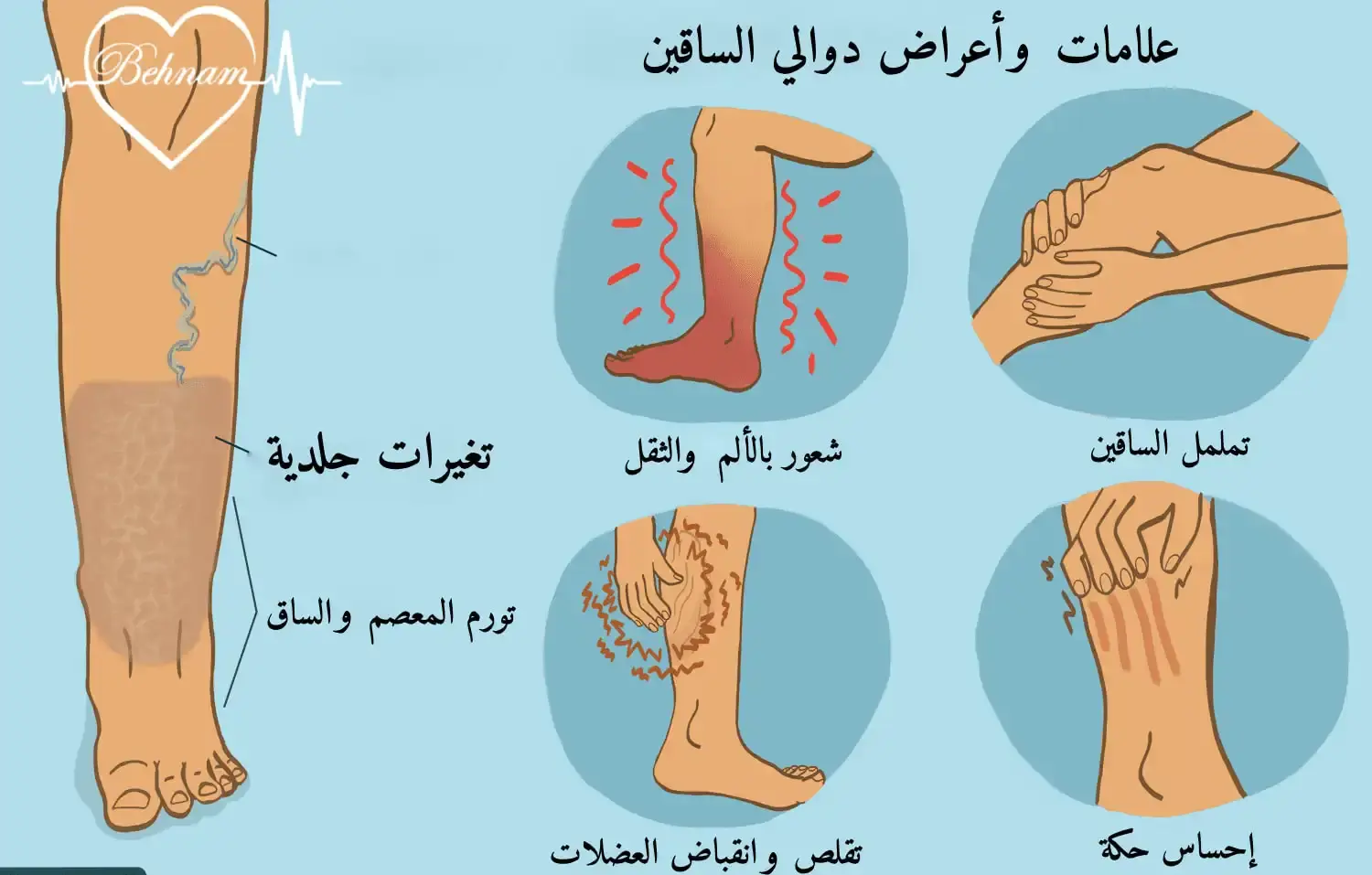 اعراض دوالی الساقین