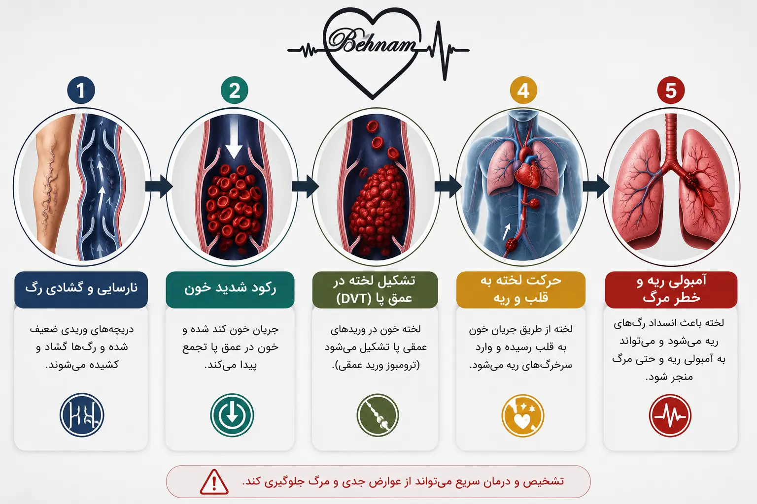 آمبولی ریه بر اثر واریس پا