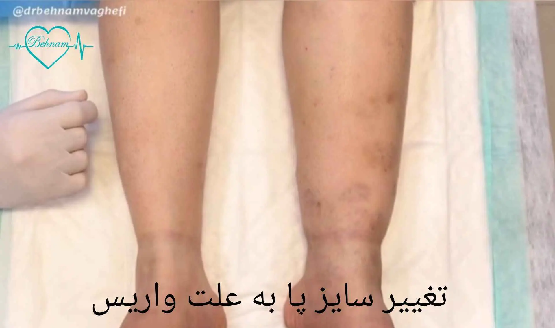 تغییر سایز پا از عوارض واریس