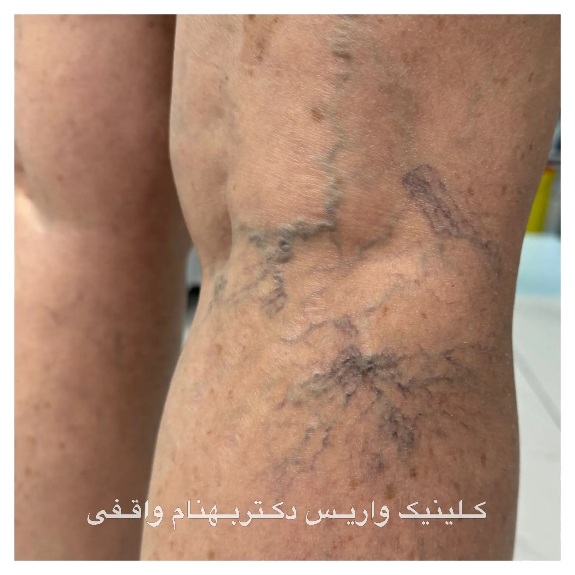  تفاوت واریس عنکبوتی و مشبک