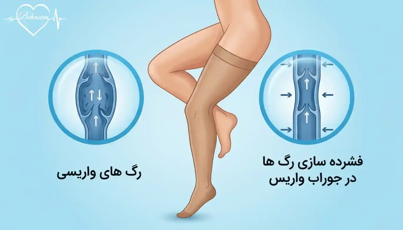 چگونگی اثر جوراب واریس