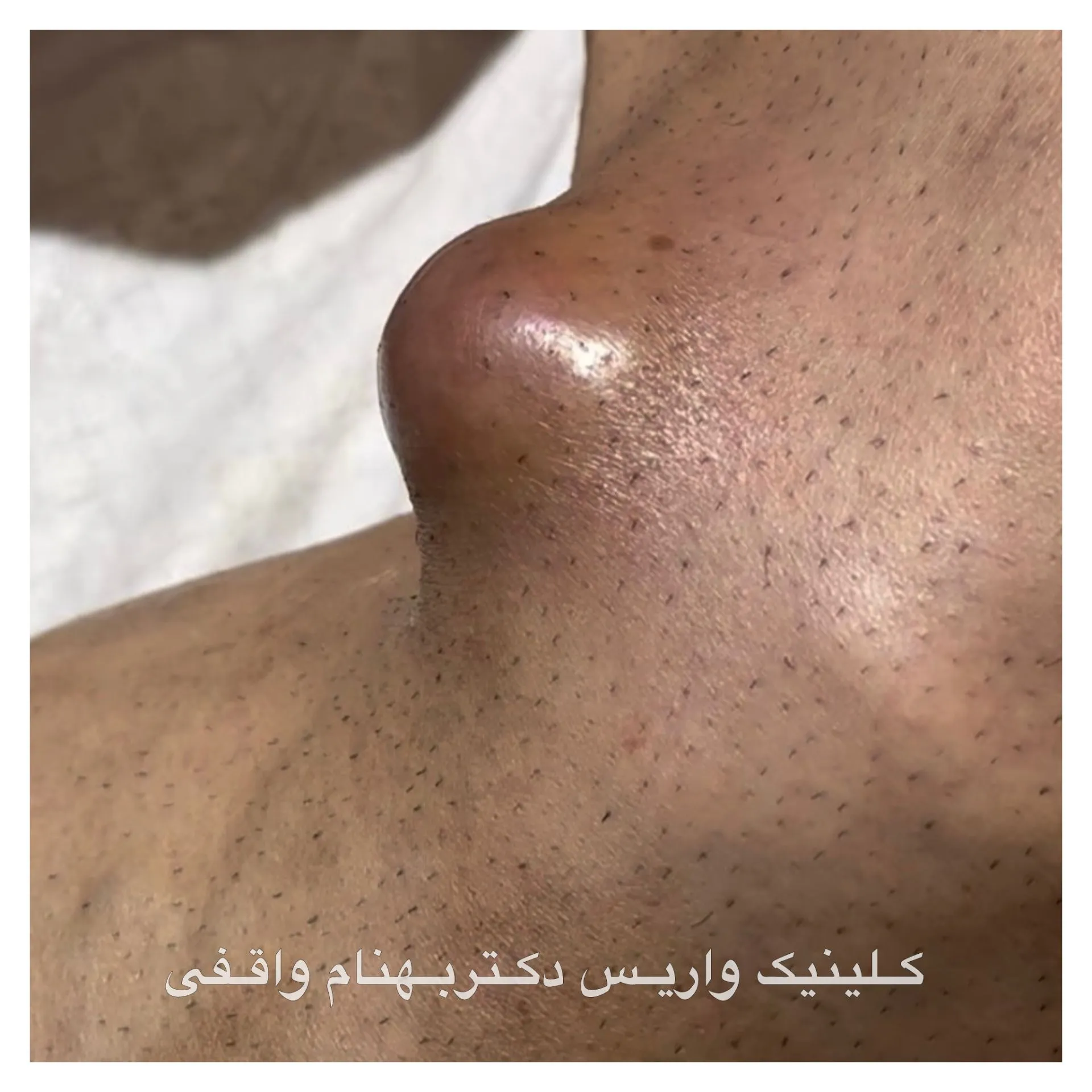 خطر لخته خون یا ترومبوز وریدی