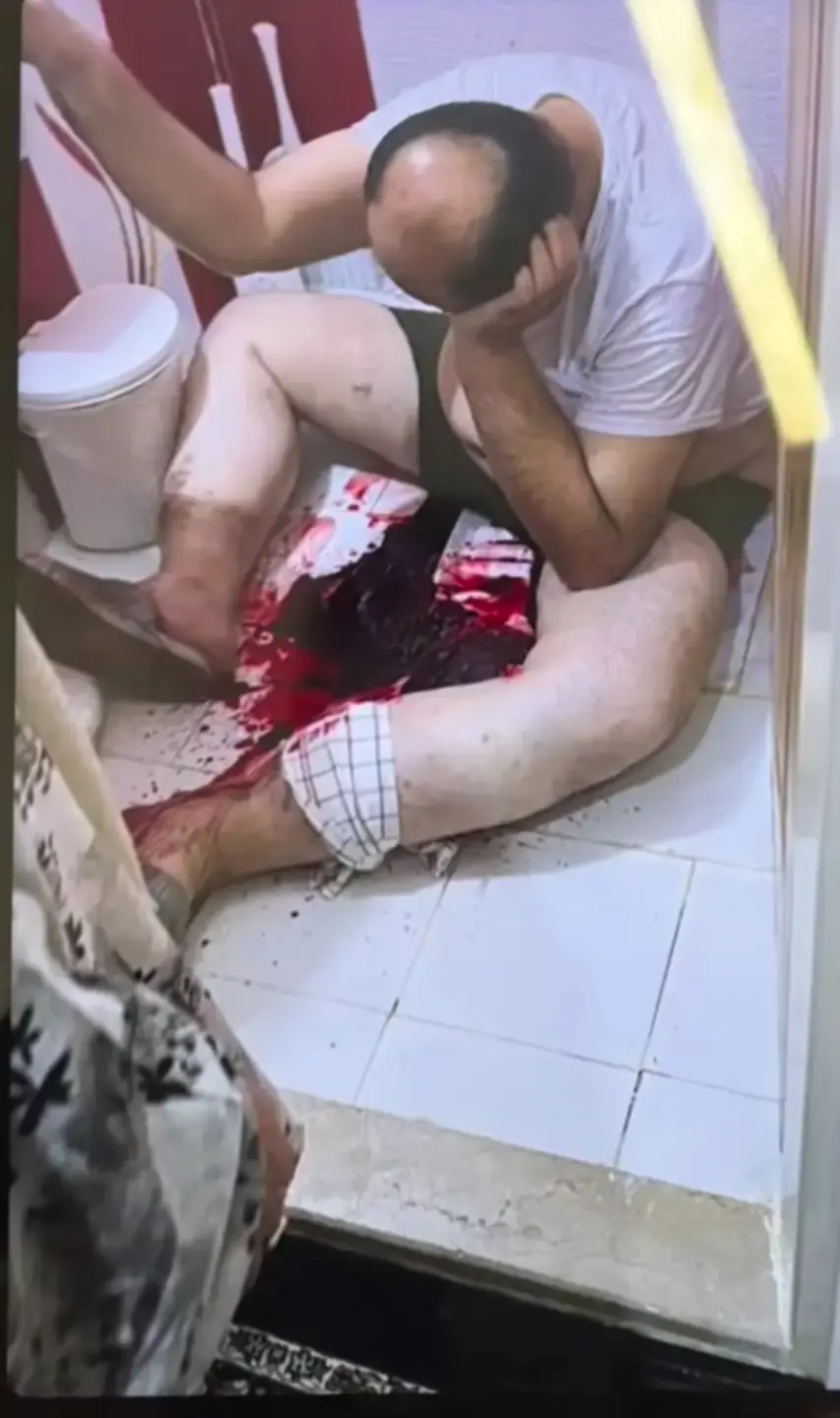 Severe blood loss due to varicose veins