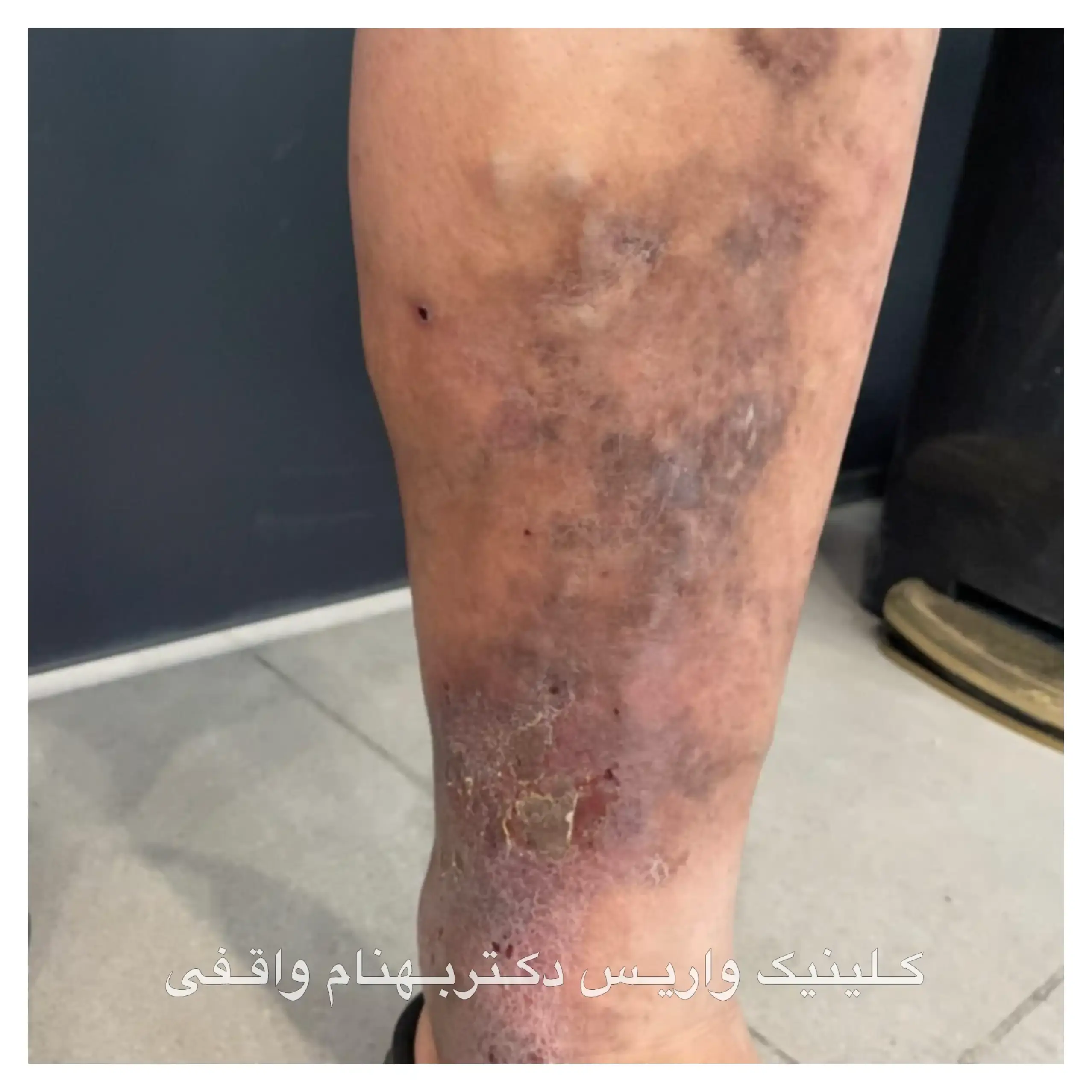 Varicose vein pain in the leg