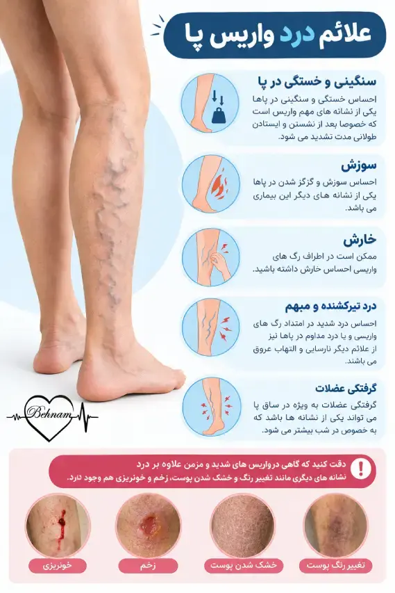 درد واریس پا