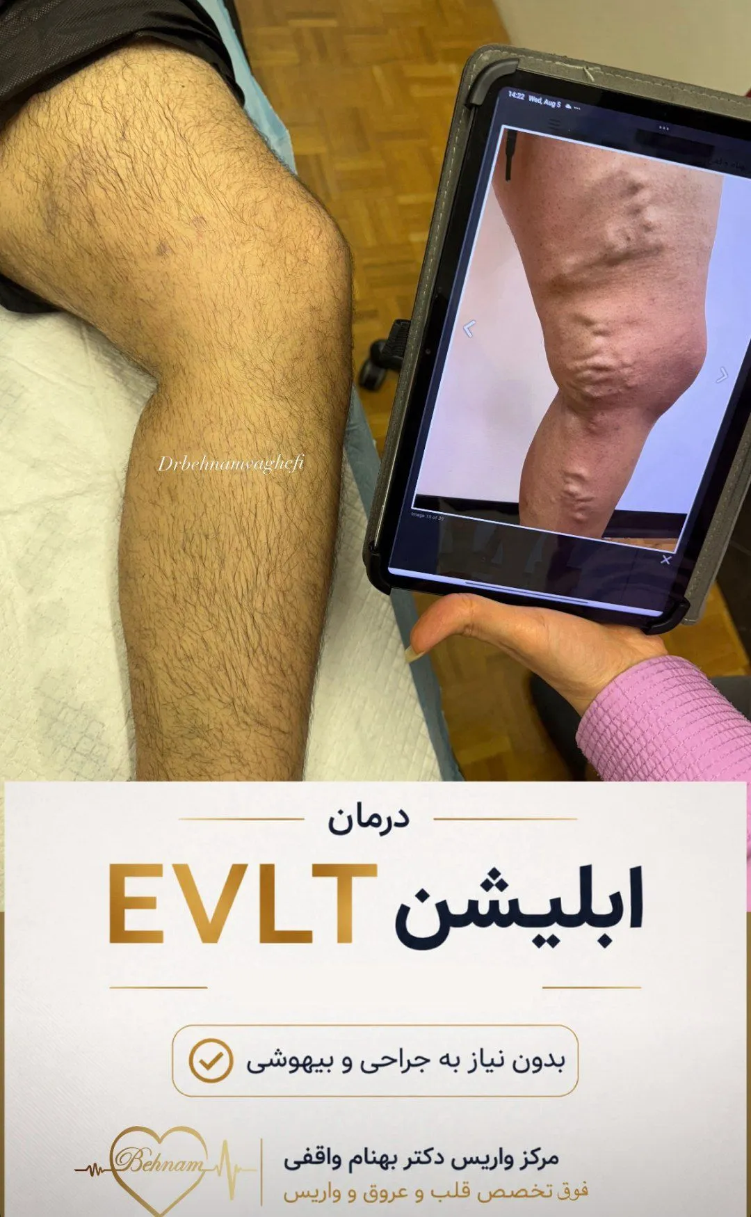 عمل واریس پا با لیزر