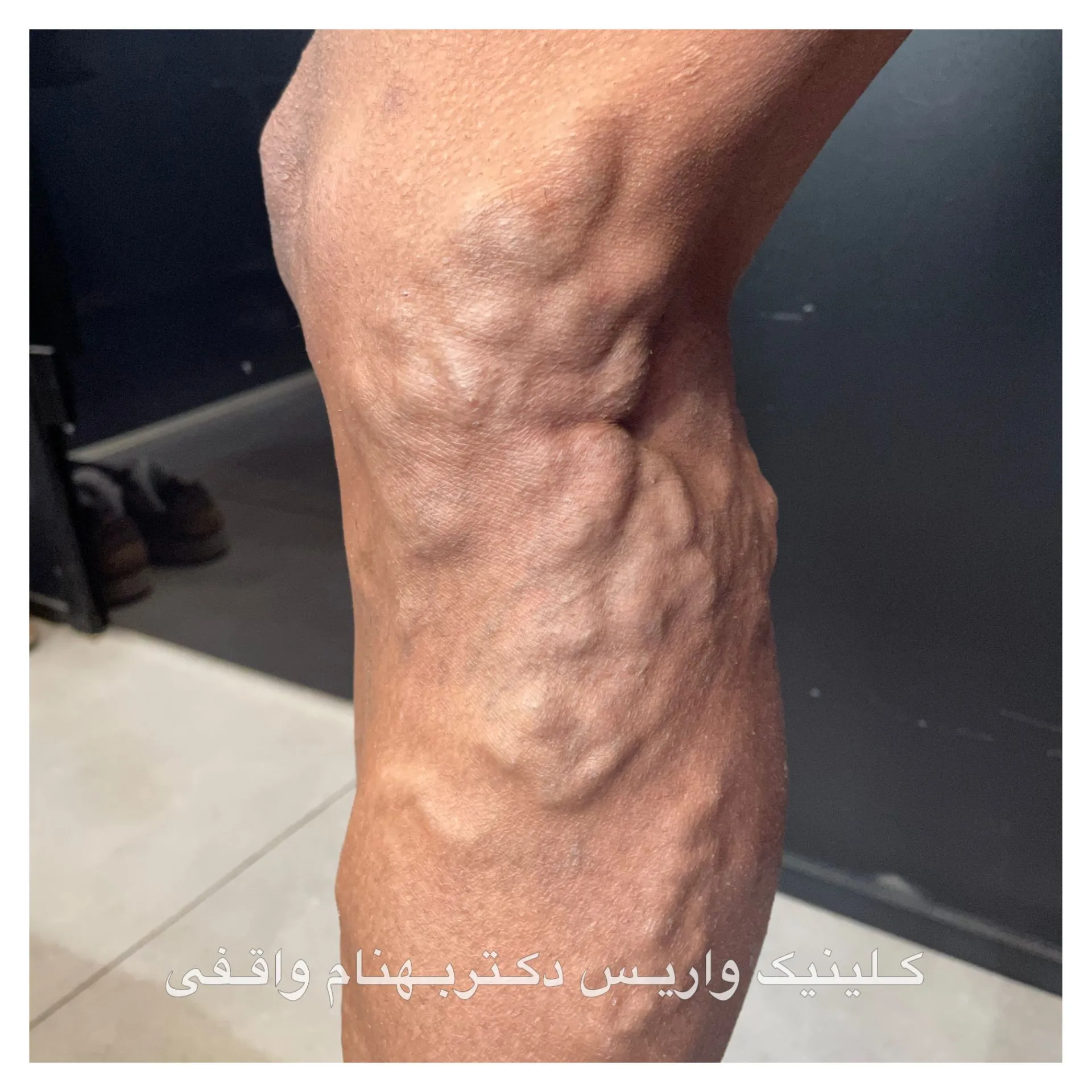 تورم و واریس رگ های پا