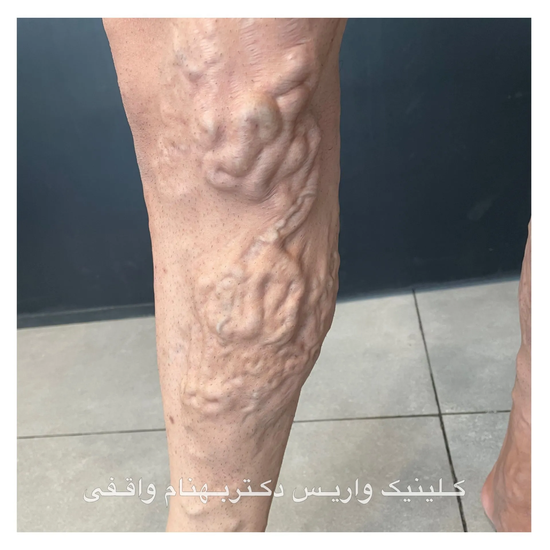 رگ های متورم و پیچ خورده پا