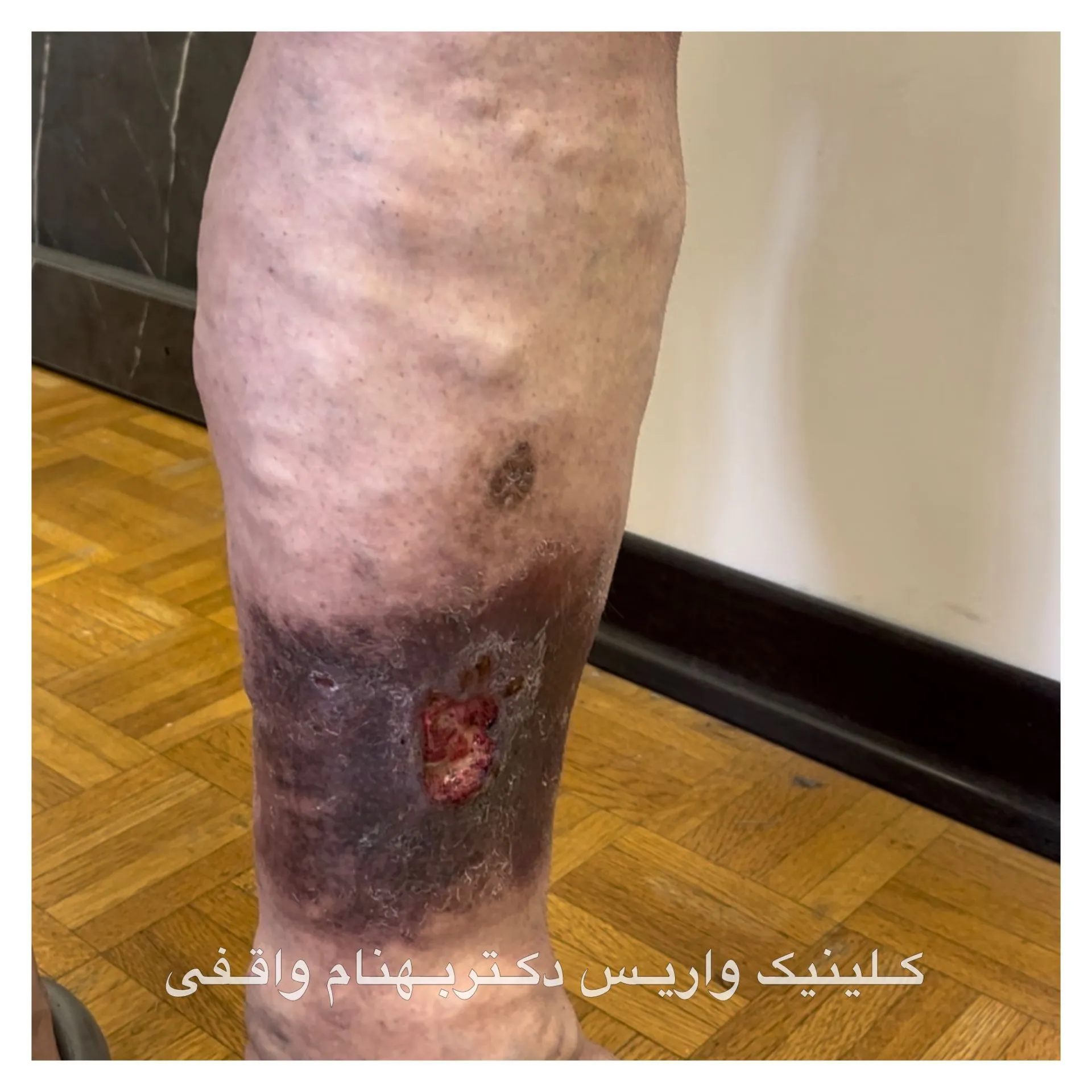 زخم و خونریزی ناشی از واریس پا