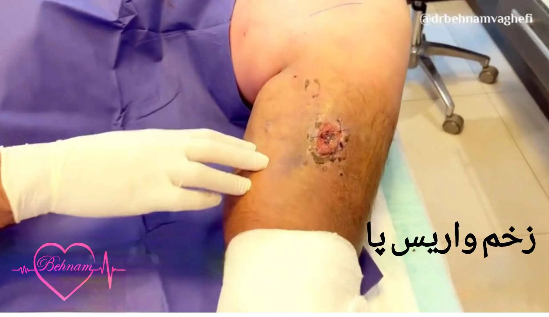 زخم پوستی عوارض واریس پا