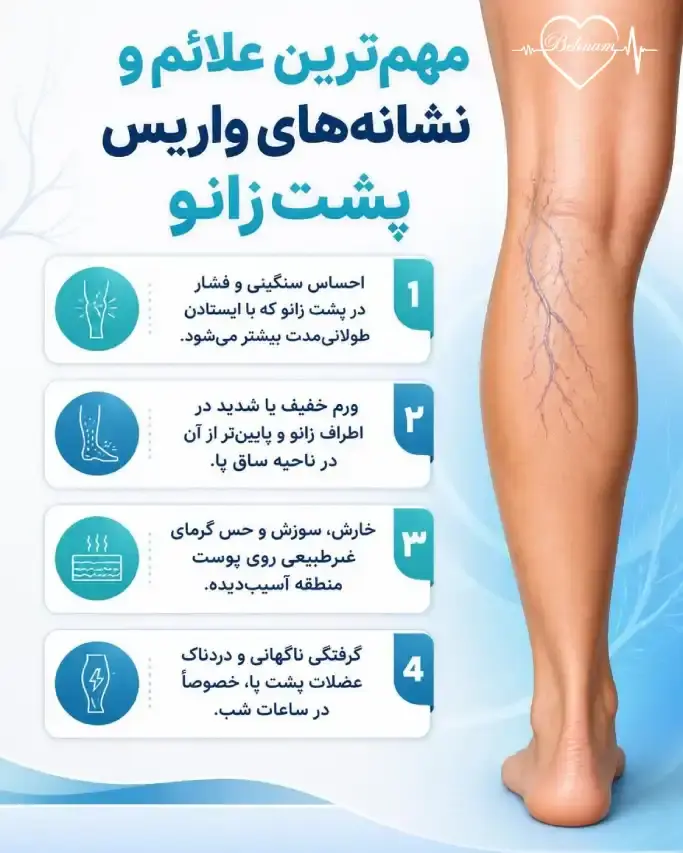 علائم واریس پشت زانو