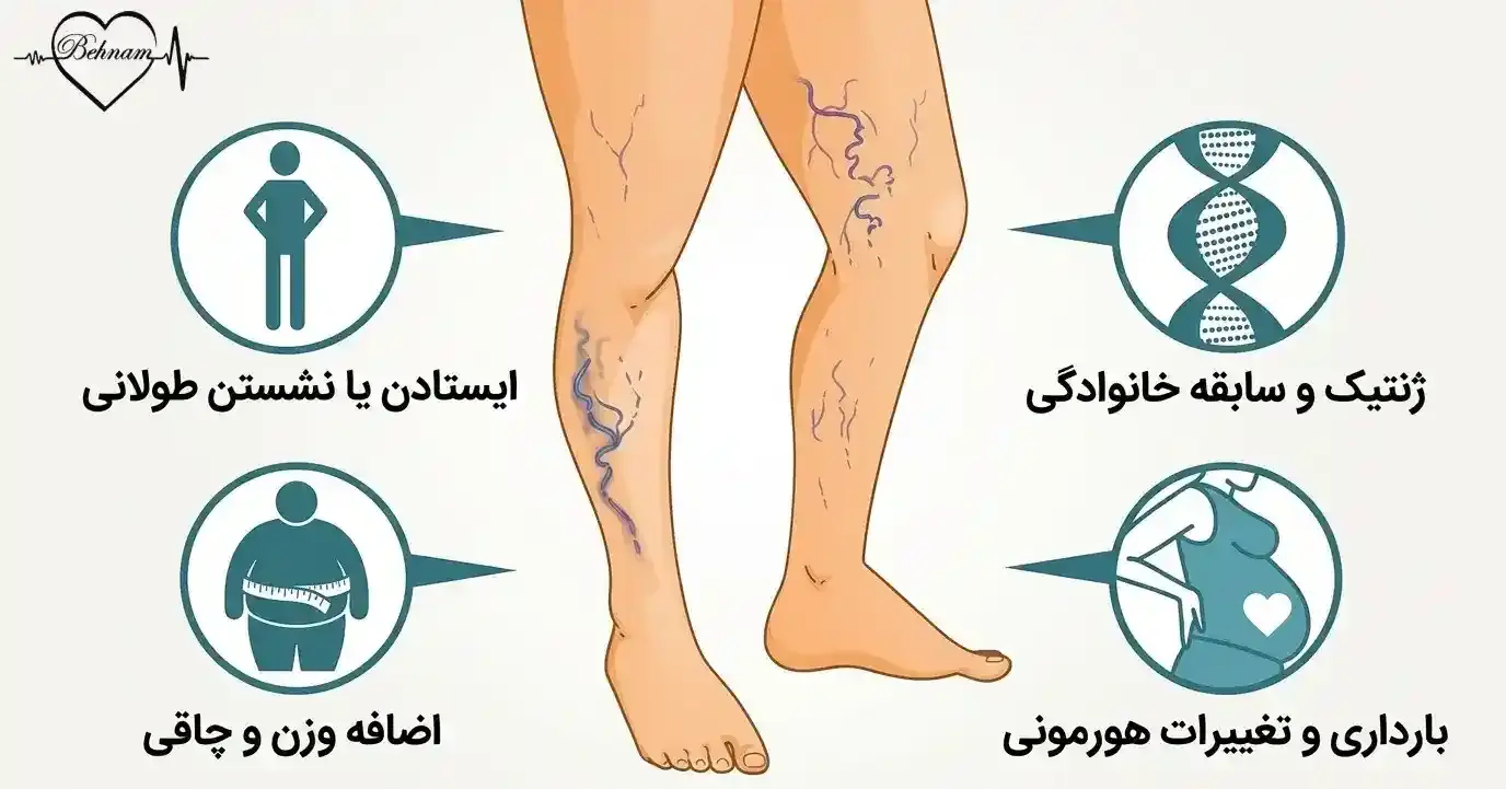 علت واریس پا