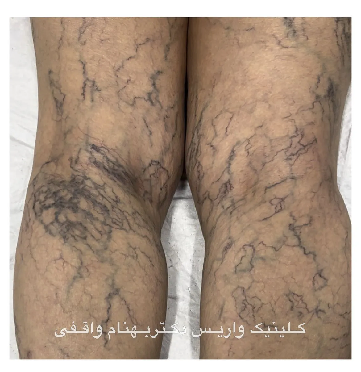 عوارض و خطر واریس عنکبوتی
