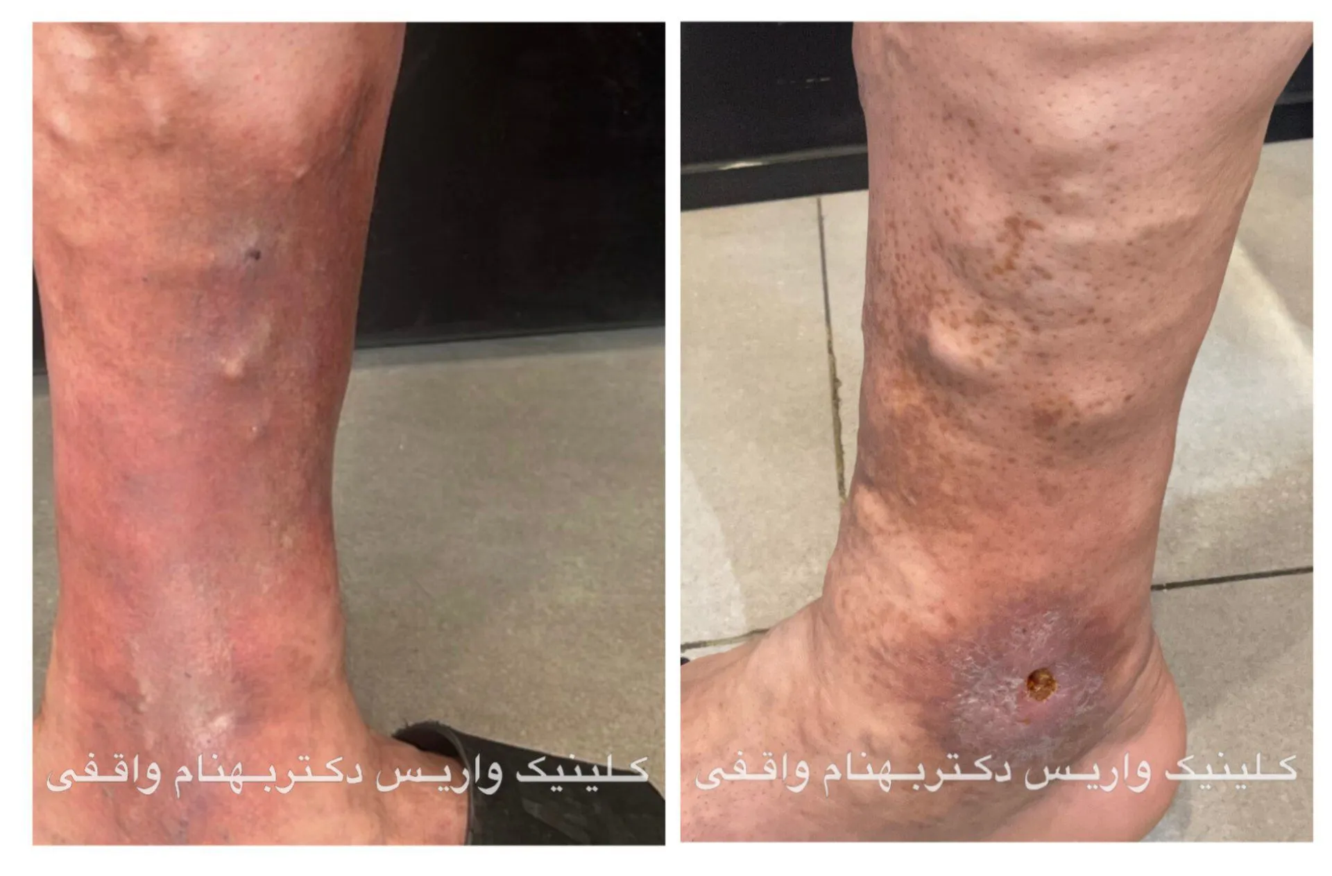 عوارض پوستی واریس طنابی