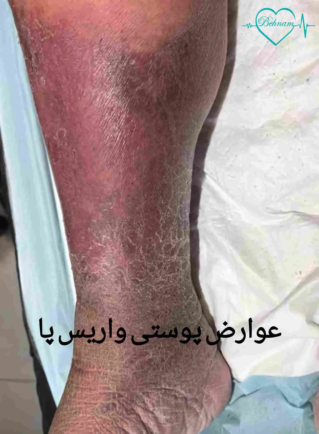 عوارض پوستی واریس پا